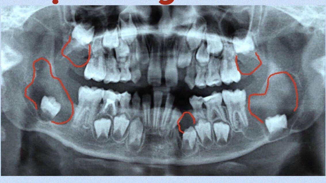 Những tổn thương dạng nang xương hàm của bé T.